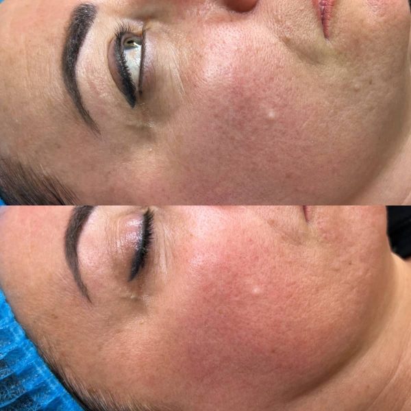 Prima e dopo needling: miglioramento di rughe e texture della pelle