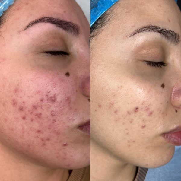 Prima e dopo needling viso su acne e cicatrici