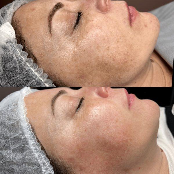 Prima e dopo needling viso su macchie solari