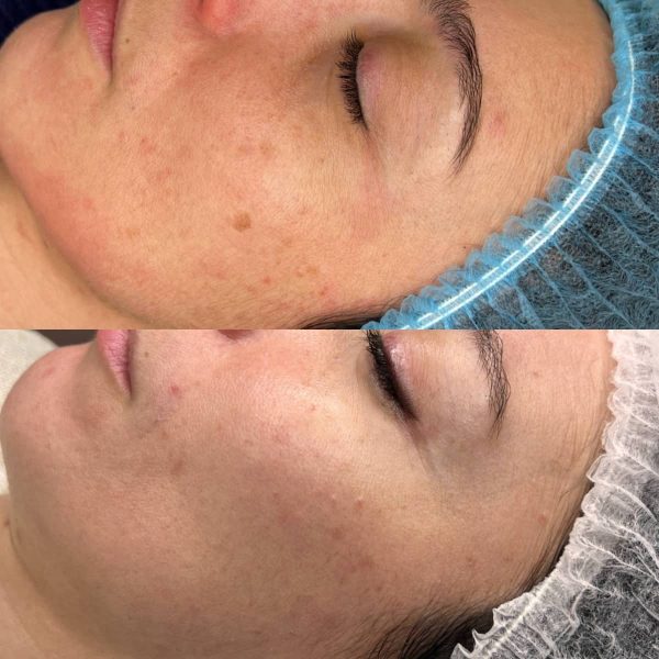 Prima e dopo needling viso: pelle più uniforme